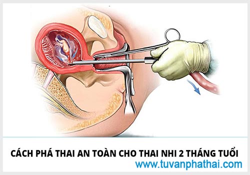 Thai 2 tháng có phá được không? Phương pháp phá thai 2 tháng